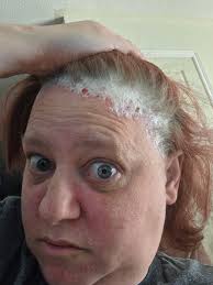 Has anybody got any recommendations for razors my psoriasis is at bay but  every one I use rips the crap out of my skin I've also tried wax and hair  removal cream