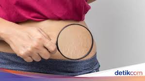 Mengenal teknologi berbasis cahaya sebagai cara menghilangkan bulu permanen. 11 Cara Menghilangkan Stretch Mark Dengan Alami Dan Efektif