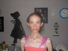 Anorexia Patient Who Weighs 58lbs Prepares For An Early Death Daily Mail Online I'm katie, of the blog: daily mail
