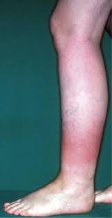 Image result for erysipel photos)