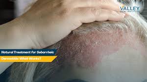 Image result for Seborrheic Dermatitis