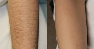 We advise that you stay out of direct and exposed light for 3 weeks following every session to keep your skin as healthy as it can be. Laser Hair Removal In Dubai Dubai Laser Treatment