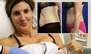 Heather McDonald attempts to zap tummy fat away with new cosmetic procedure  | Daily Mail Online