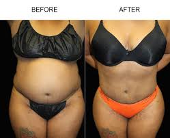 Liposuction Tampa | Lipo 360 Tampa