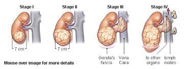 Previous bladder or kidney cancer. Renal Cancer Physiopedia