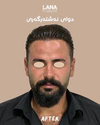 نەشتەرگەری جوانکاری لوت لەلایەن دکتۆرە لانە ئازاد پزیشکی پسپۆڕی نەشتەرگەری  قوڕگ و لوت و گوێ پەیوەندیمان پێوە بکەن: 07702688787