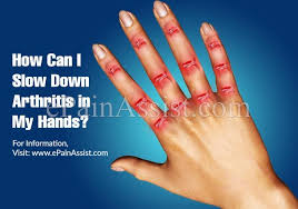 Pin On Arthritis