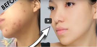 In case your scar has some pigmentation, use lemon juice on it to lighten it up. How To Fade Red Scars Novocom Top