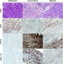 Approximately 3000 new cases of mesothelioma are . Expression Of V Set Immunoregulatory Receptor In Malignant Mesothelioma Modern Pathology