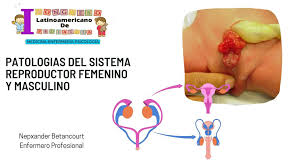 El gameto masculino, o espermatozoide, y el gameto femenino, u óvulo, se unen en el sistema reproductor femenino. Patologias Del Sistema Reproductor Femenino Y Masculino Sistema Reproductor Patologias Ninos Udocz
