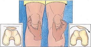 Image result for Patellar Apprehension Test