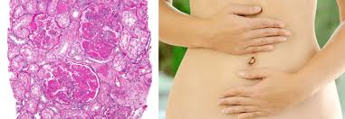 Lupus can cause disease of the skin, heart, lungs, kidneys, joints, and nervous system. Dysbiose Konnte Systemischen Lupus Triggern Medical Tribune
