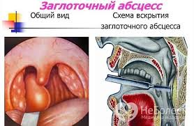 Angina Gnojnaya Simptomy I Lechenie V Domashnih Usloviyah Gorodskaya Klinicheskaya Bolnica 1