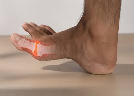 Image result for gout