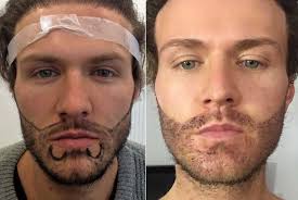 A beard transplant, also called a facial hair transplant, is a surgical procedure that harvests hair follicles from one part of the body and transplants them into the mustache, beard, and sideburns. Beard Transplant Beard Transplant Cost Procedure Clinics Dhi International