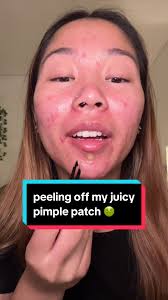 Peeling off My Juicy Pimple Patch: A Skincare Adventure