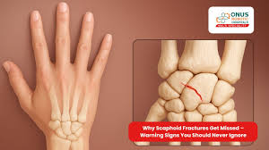 Image result for Scaphoid Fracture Signs