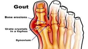 We did not find results for: Nyeri Pada Sendi Sendi Kaki Rumah Sakit Jih The Ultimate Value Healthcare