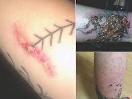 Persistent bumps, bubbles, or pustules at the site of tattoo may also indicate infection, says dr. Tattoo Infection 101 How Do You Know If Your New Ink Is Infected