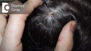 Image result for white scabs on the head in children