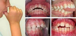 Por Que Los Dientes Torcidos Te Pueden Causar Problemas