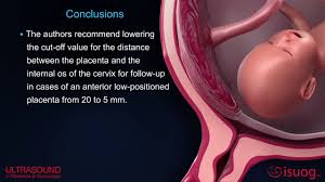 They can have a significant influence on a reader's experience of your paper. New Uog Video Abstract On Placenta Previa And Low Lying Placenta Second Trimester Ultrasound Youtube