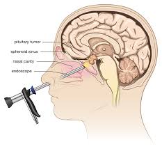 Pituitary disorder management