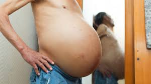 Image result for Ascites