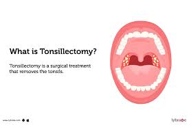 Image result for Tonsillectomy