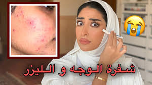 تجربتي مع ازالة شعر الوجه بالشفره و الليزر انصدمت فاطمة المهنا Youtube