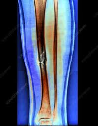 A spiral fracture is when a bone breaks in a helix pattern under a twisting or torsion force. Spiral Fracture Keyword Search Science Photo Library