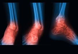 Image result for Osteomyelitis