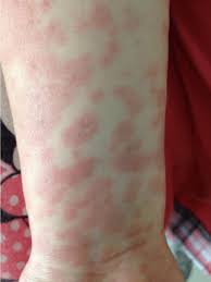 Some patients amoxicillin rash is common to girls than boys. Polymorphic Exanthem Induced By Amoxycillin In A Child Case With Infectious Mononucleosis