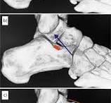 The role of arthroereisis of the subtalar joint for flatfoot ...