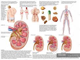 medical chart with the signs and symptoms of kidney stones