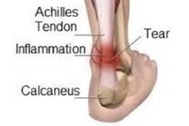 Check spelling or type a new query. Pain In The Back Of Your Heel It May Be Achilles Tendinopathy Brindabella Podiatry