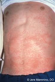 Drug Eruptions American Osteopathic College Of Dermatology Aocd