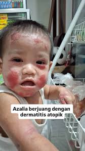 Disclaimer: Kombucha bukan OBAT ya, tapi berisikan bakteri baik yang  membantu menjaga daya tahan tubuh dan meningkatkan polupulasi bakteri baik  baik di pencernaan maupun di kulit. Saya memberikan Ifah dan keluarga  kombucha