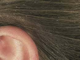 In rare cases, head lice can crawl onto a person's clothing and on to another person's hair and scalp, but this must happen quickly. Head Lice 101 What Lice Look Like How They Behave And How Kids Get Them Babycenter