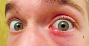 Doing so can cause the infection to spread. What Is An Eye Stye Bard Optical