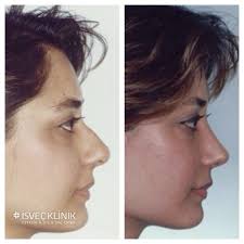 Adana Nan Isvec Klinigi Tercih Eden Nesibe N Nin Burun Estetigi Oncesi Ve Sonrasi Inanilmaz Degisimi Rhinoplasty Nose Jobs Nose Plastic Surgery Nose Surgery
