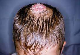For example, ringworm is a skin infection caused by a fungus—not a worm! Scalp Ringworm Symptoms Pictures Treatment Cure