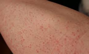 There are a few ways you can exfoliate, but exfoliation via acids (like glycolic, salicylic, and lactic) is the easiest and fastest route. Ingrown Hair Natural Ways To Get Rid Of Them Easily Shongruff