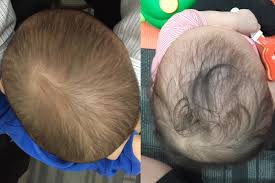 متى تكون النتائج أفضل مع خوذة علاج الرأس المسطح PioHelmet؟