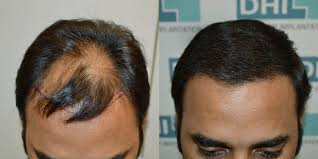 What are causes and risk factors for hair loss? What Causes Hair Loss Dhi Philippines