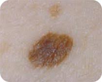 The strongest risk factor for developing skin cancer is ultraviolet (uv) ray exposure, typically from the sun. Skin Cancer Overview Cancer Council Victoria