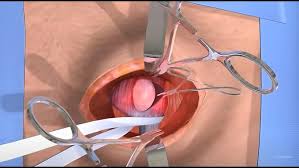 Hernia repair surgery