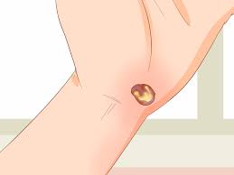 Your skin rubbing something repeatedly (like a shoe) or being pinched (like in a door) is likely the cause. 5 Ways To Treat A Blood Blister Wikihow