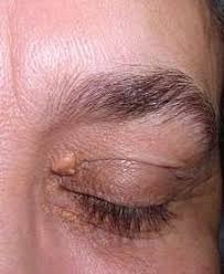 Image result for xanthelasma of eyelid
