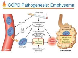 Image Result For Copd Pathophysiology Respiratory System